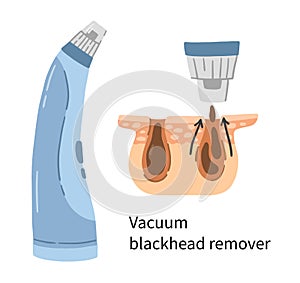 Vacuum blackhead remover illustration with layers of dermis and pores