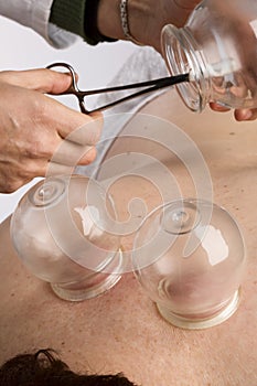 Vacuum cupping