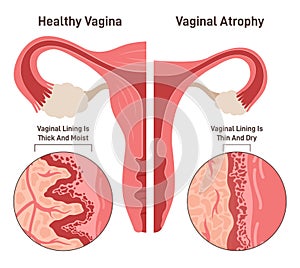 Vaginal atrophy. Thinning, drying and inflammation of the vaginal walls