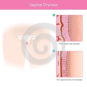 Vaginal Dryness. photo