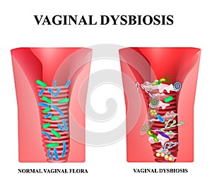 Vaginal dysbiosis. Dysbacteriosis of the vagina. Vaginitis Candidiasis. Lactobacillus, bifidobacteria. Bacteria pathogenic flora. photo