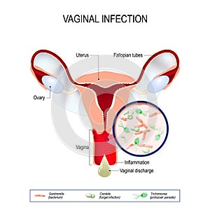 Vaginal infection and causative agents of vulvovaginitis.