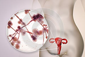 Vaginal thrush, female candidiasis