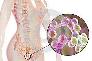 Vaginal thrush, female candidiasis