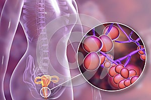 Vaginal thrush, female candidiasis photo