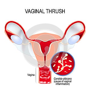 Vaginal yeast infection and Candida albicans photo