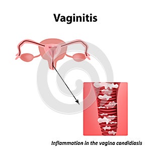 Vaginitis. Inflammation in the vagina candidiasis thrush. The structure of the pelvic organs. Infographics. Vector photo