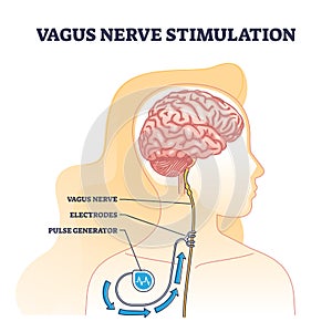 Vagus nerve stimulation as medical device implant for brain outline diagram