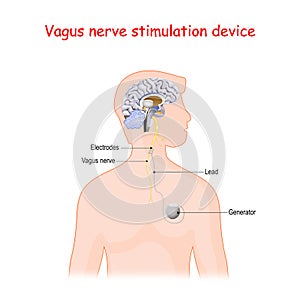 Vagus nerve stimulation device