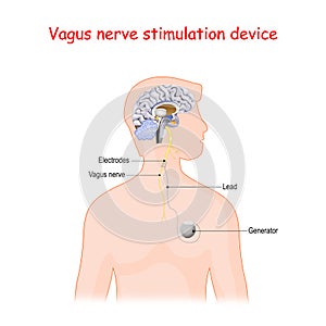 Vagus nerve stimulation device photo