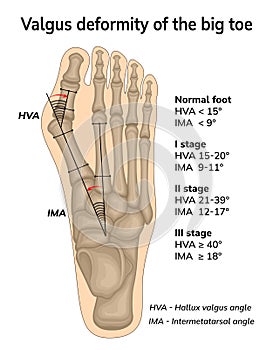 Valgus deformity of the big toe
