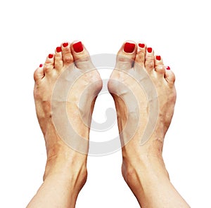 Valgus deformity of legs due of the cross flatfoot (hallux valgus). photo