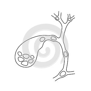 Variants of the location of stones in the gallbladder and bile ducts. Schematic drawing for cholelithiasis, gallstone photo