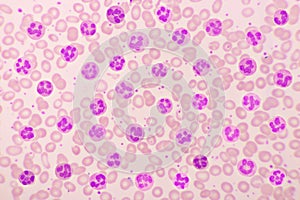 Variation of normal neutrophil cells or PMN cells in blood smear photo
