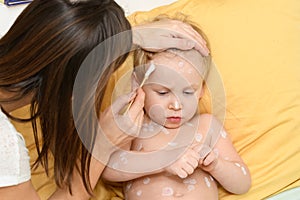 Varicella virus or Chickenpox bubble rash on boy