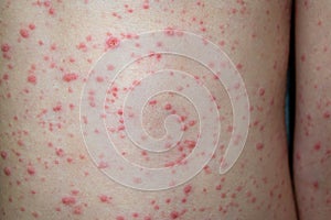 Varicella virus or Chickenpox bubble rash on child