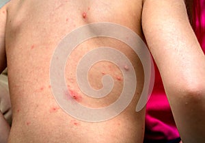 Varicella zoster virus or Chickenpox bubble rash on child, baby