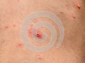 Varicella zoster virus or Chickenpox bubble rash on child, baby