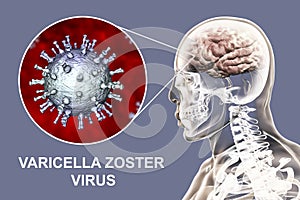 Varicella zoster virus encephalitis