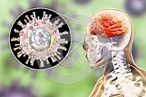 Varicella zoster virus encephalitis