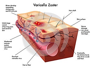 Varicella zoster virus photo