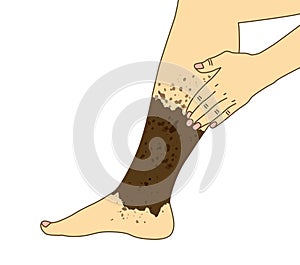 Varicose chronic or blood clot on calf leg syndrome, diabetes disease, illustration on white background