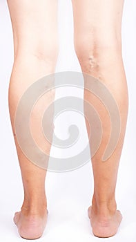Varicose expansion veins on female legs ,disease phlebeurysm