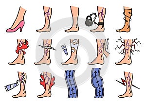 Varicose treatment icons set. Violation of circulatory system. Vascular disease diagnostic. Venous insufficiency medical