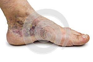 Varicose vein