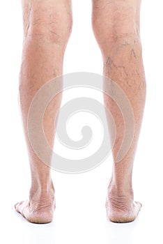 Varicose vein Isolated on white