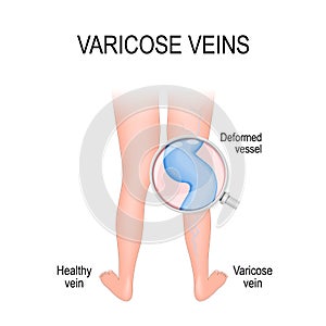Varicose vein and normal vein