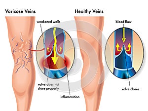 Varicose veins photo