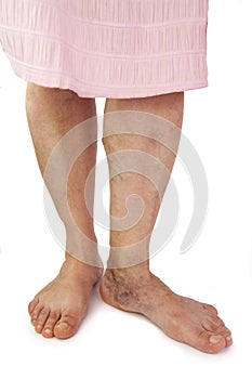 Varicose veins