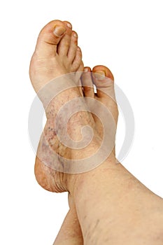 Varicose veins