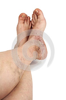 Varicose veins