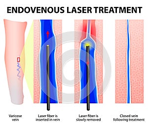 Varicose Veins