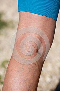 Varicose veins