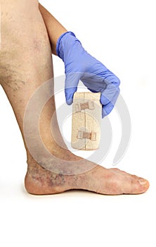 Varicose veins and bandage