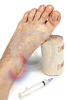 Varicose veins and bandage