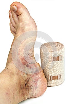 Varicose veins and bandage