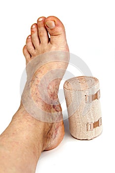 Varicose veins and bandage