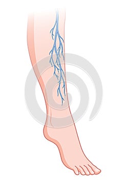 Varicose veins. Blue blood vessel visible through the skin, abnormally swollen leg. Vascular disease diagnostic and