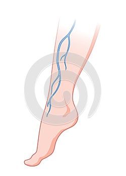 Varicose veins. Blue blood vessel visible through the skin, abnormally swollen leg. Vascular disease diagnostic and