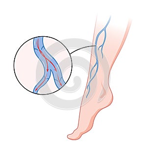 Varicose veins. Blue blood vessel visible through the skin, abnormally swollen leg. Vascular disease diagnostic and