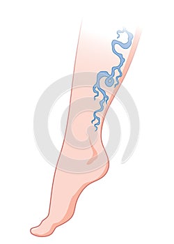 Varicose veins. Blue blood vessel visible through the skin, abnormally swollen leg. Vascular disease diagnostic and