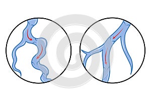 Varicose veins. Blue blood vessel visible through the skin. Vascular disease diagnostic and treatment. Venous