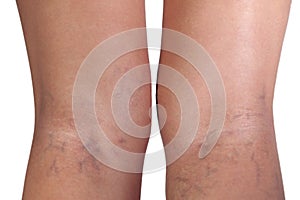 Varicose veins close up