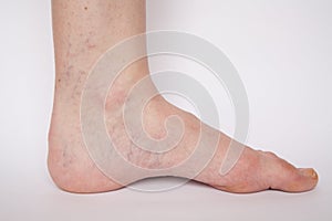 Varicose veins closeup