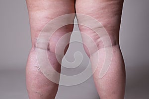 Varicose veins closeup, fat female cellulite legs