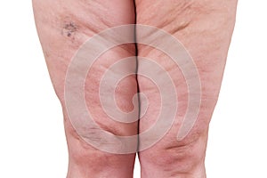 Varicose veins closeup, fat female legs isolated on white background